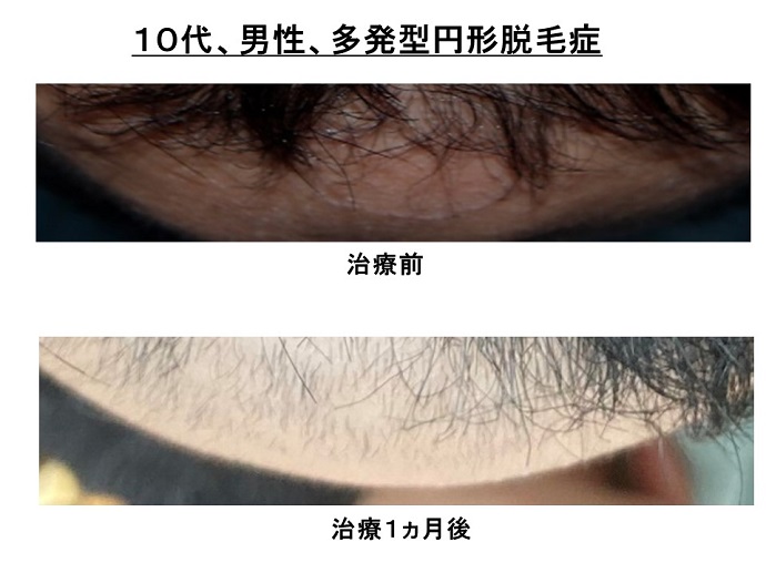 円形脱毛症　病院